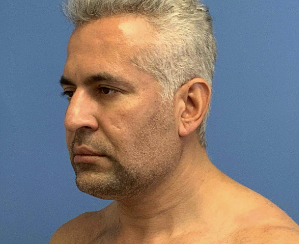 Facetite--amp--Liposuction | After Face